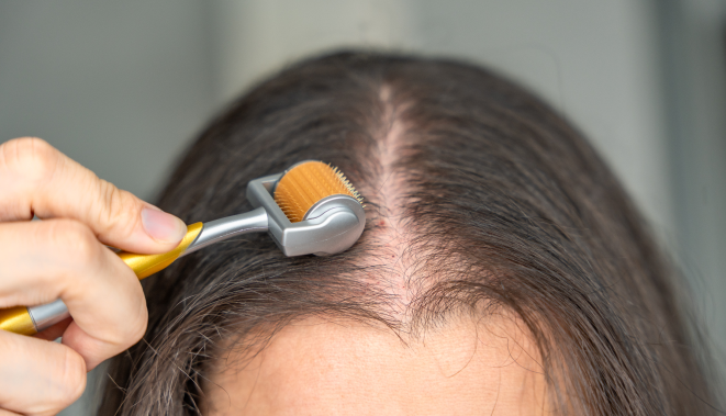 Derma Roller for Hair Loss: A Safe, Effective Treatment to Conduct on Your Own